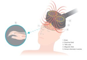 Side effects of transcranial magnetic stimulation